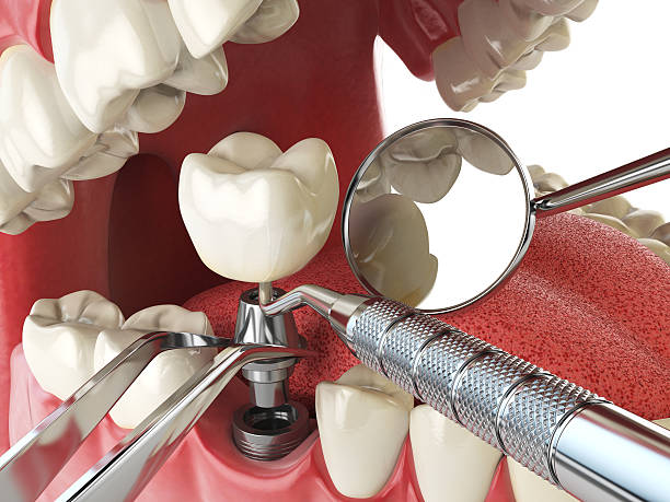 Best Emergency Gum Treatment in Leo Cedarville, IN